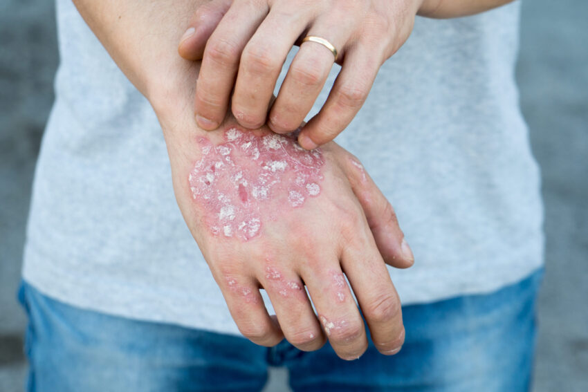 Topic Steroid Withdrawal